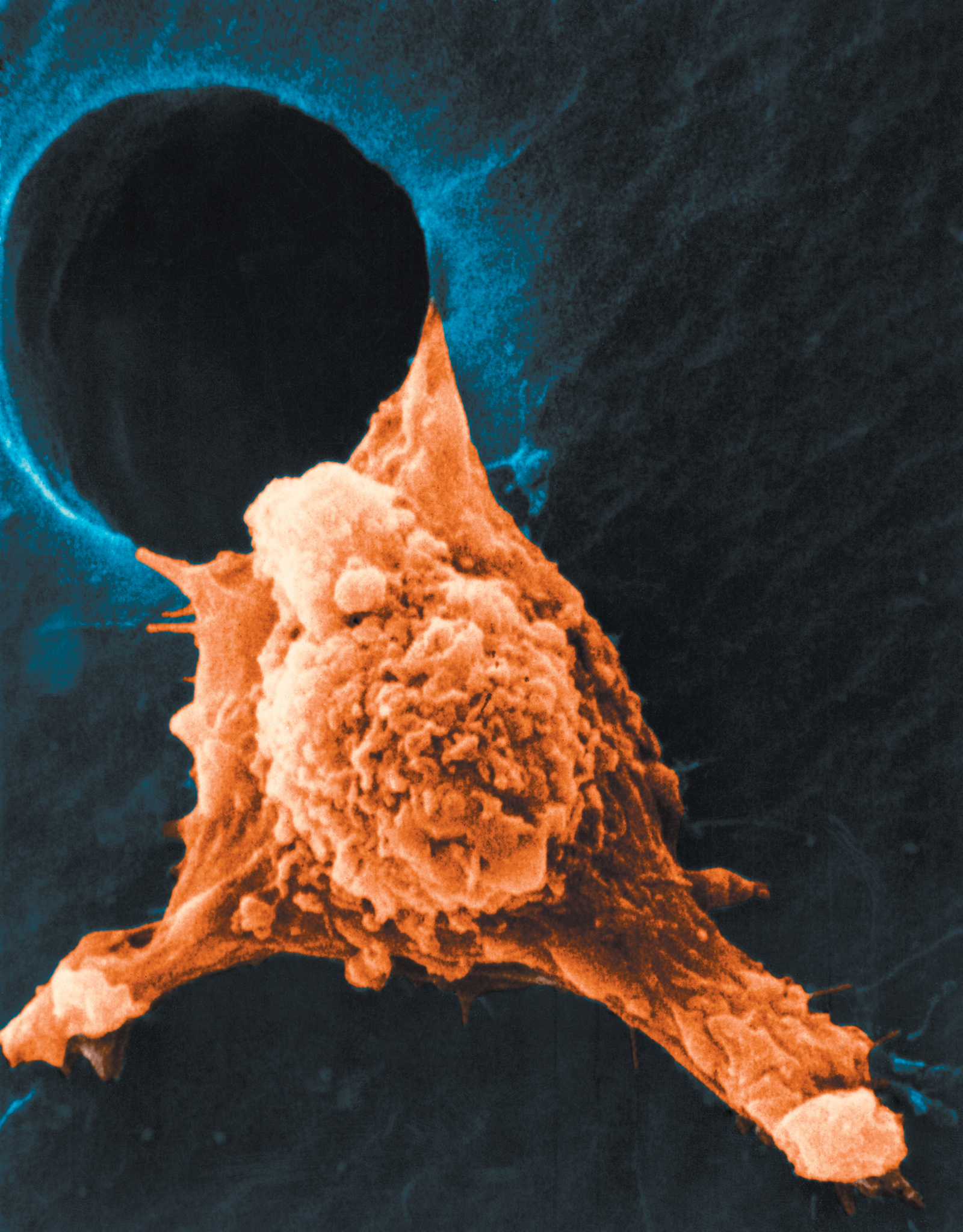 A color-enhanced scanning electron micrograph showing the spread of cancer cells