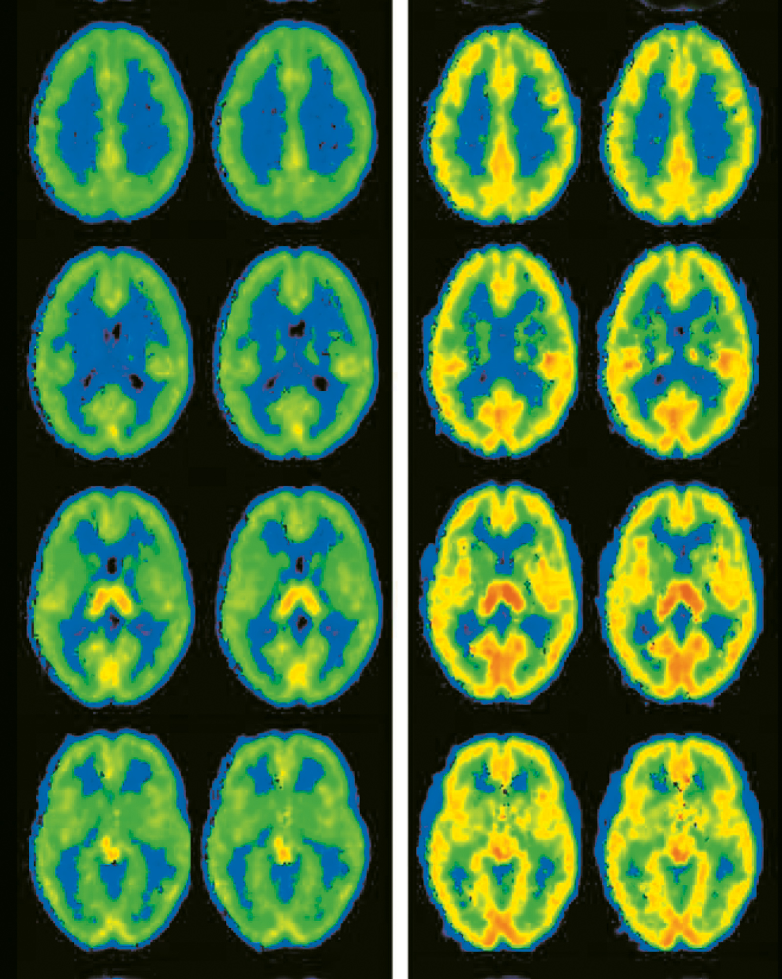 Nelly Alia-Klein et al., “Brain ­Monoamine ­Oxidase A Activity ­Predicts Trait ­Aggression,” Journal of Neuroscience, May 7, 2008