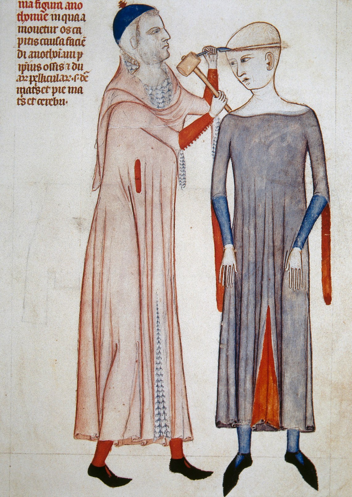 Illustration of trepanning from an anatomical treatise by the Italian physician Guido da Vigevano, 1345