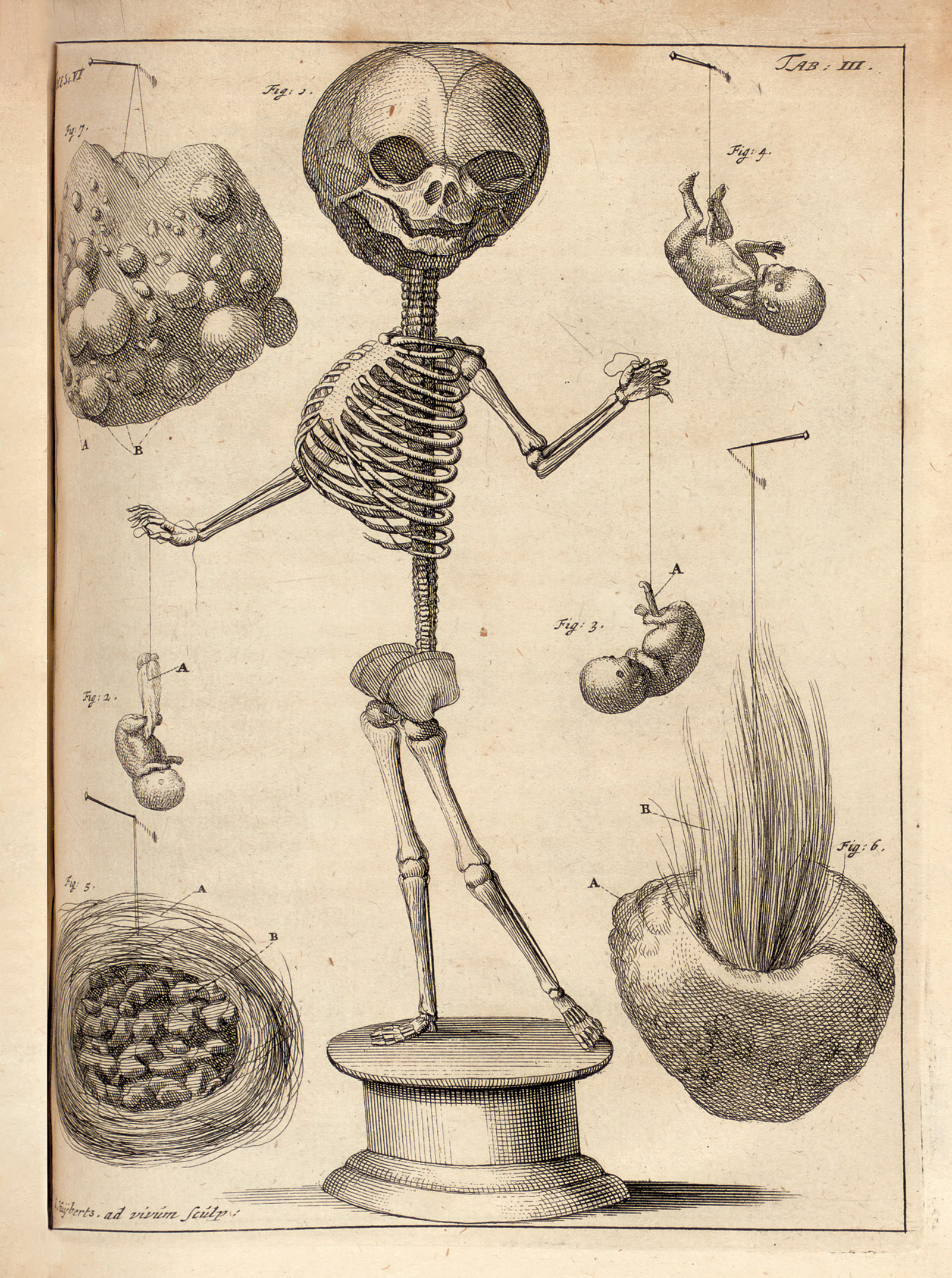 Engraving depicting the skeleton of a four-month-old infant with human embryos, a human placenta, and scar tissue and hair from a cow’s neck